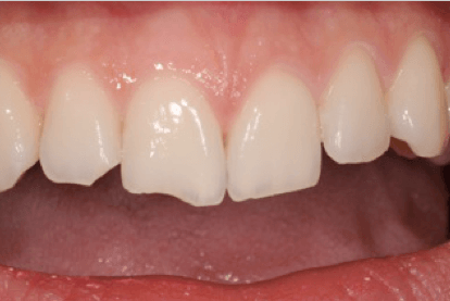 traumi-dentali-1