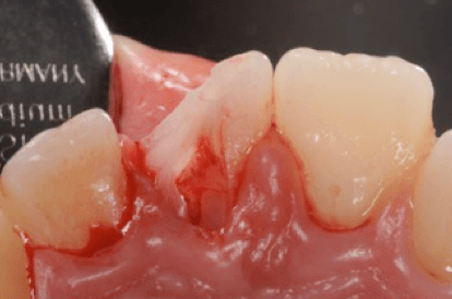 traumi-dentali-3